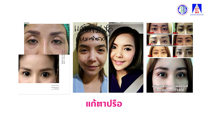 แก้ตาปรือ แก้ตาปรือ