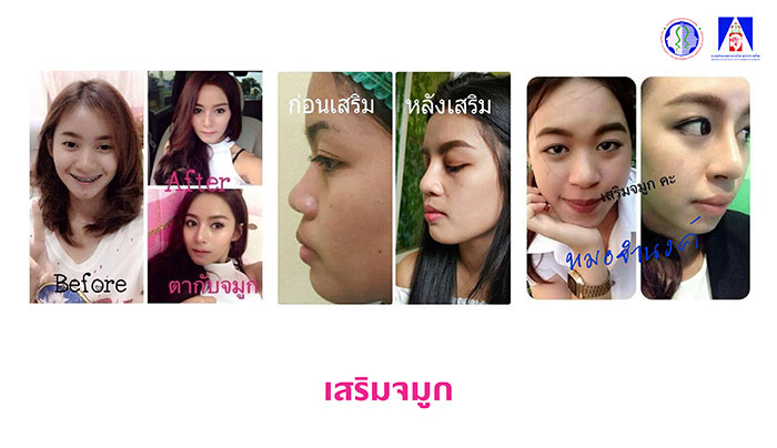 เสริมจมูก เสริมจมูก