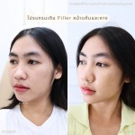 ฟิลเลอร์ รัชดา - บริษัท เคเจ คลินิก จำกัด