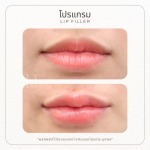 ฟิลเลอร์ปาก อินทามระ - บริษัท เคเจ คลินิก จำกัด