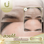 ฉีดโบลดริ้วรอย ชลบุรี