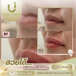 ฉีดฟิลเลอร์ปาก บางแสน ศรีราชา ชลบุรี