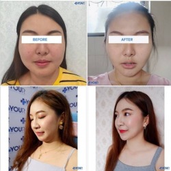 เมโสแฟต เชียงราย