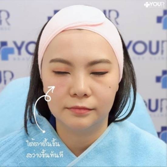 ฉีดฟิลเลอร์ใต้ตา เชียงราย ฟิลเลอร์ใต้ตา เชียงราย 