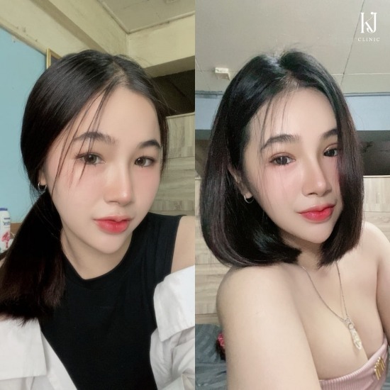 ทำตาสองชั้น ที่ไหนดี ฉีดโบท็อกรัชดา  ฉีดโบท็อกอินทามระ  Botox ราคาถูก  โปรแกรมหน้าใส รัชดา  โปรแกรมหน้าใส อินทามระ  รักษาฝ้า รัชดา  รักษาฝ้า อินทามระ  รักษาสิว รัชดา  วิตามินผิว รัชดา  เสริมจมูก รัชดา 