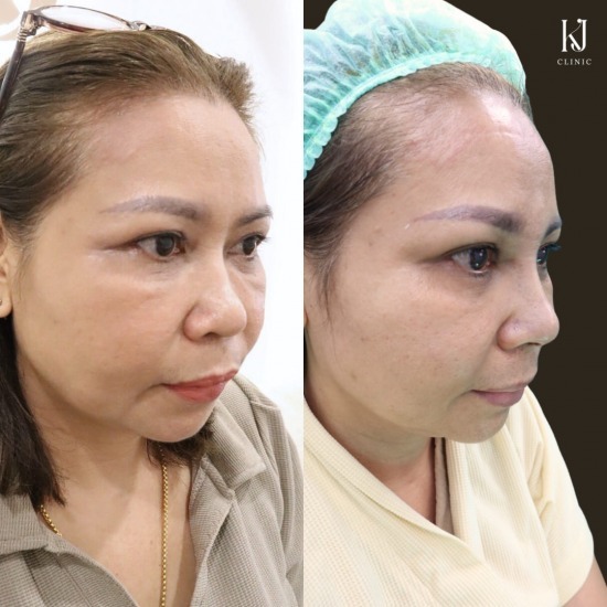 เสริมจมูก อินทามระ ฉีดโบท็อกรัชดา  ฉีดโบท็อกอินทามระ  Botox ราคาถูก  โปรแกรมหน้าใส รัชดา  โปรแกรมหน้าใส อินทามระ  รักษาฝ้า รัชดา  รักษาฝ้า อินทามระ  รักษาสิว รัชดา  วิตามินผิว รัชดา  เสริมจมูก รัชดา 