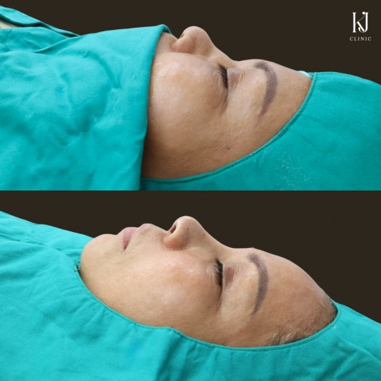 เสริมจมูกsemi open รัชดา ฉีดโบท็อกรัชดา  ฉีดโบท็อกอินทามระ  Botox ราคาถูก  โปรแกรมหน้าใส รัชดา  โปรแกรมหน้าใส อินทามระ  รักษาฝ้า รัชดา  รักษาฝ้า อินทามระ  รักษาสิว รัชดา  วิตามินผิว รัชดา  เสริมจมูก รัชดา 