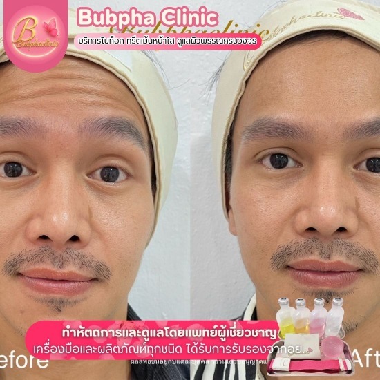 บริการโบท็อก อุดมสุข คลินิกความงาม อุดมสุข บางนา  คลินิกรักษาสิวกดสิว อุดมสุข  บริการโบท็อก อุดมสุข  ทรีตเมนต์หน้าใส อุดมสุข  ฉีดเมโส บางนา  เลเซอร์ขน เลเซอร์หน้า อุดมสุข บางนา  คลินิกทรีทเม้นท์หน้าใกล้ฉัน  คลินิกความงาม BTSอุดมสุข  ดริปวิตามิน BTSอุดมสุข  ดริปวิตามินผิวขาว อุดมสุข 